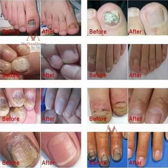 MeiYanQiong-Herbal-Nail-Fungus-Treatment-Onychomycosis-Paronychia-Anti-Fungal-Nail-Infection-Chinese-Herbs-Toe-Nail-Repair