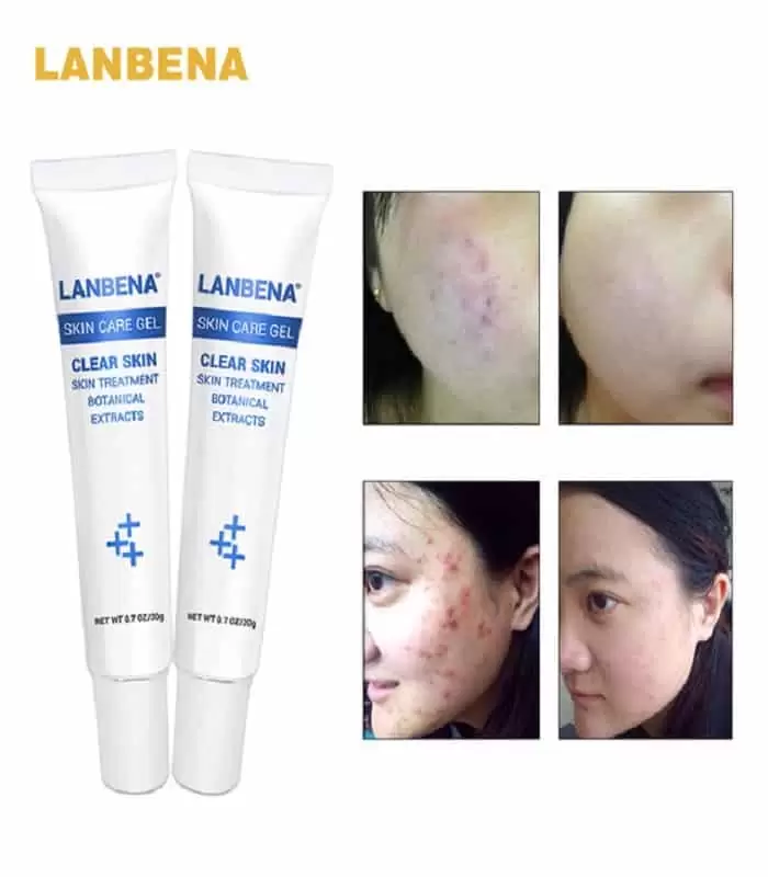 Lanbena Acne Treatment Gel